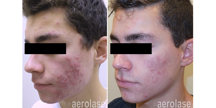 acne pinski teen after 4 treatments