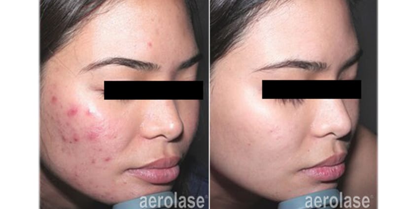 neoclear acne treatment spade skin care