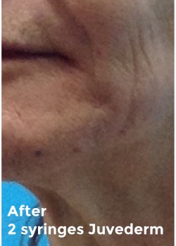 After Image: Filler - front