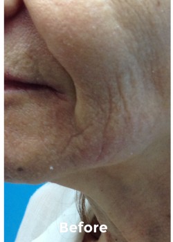 Before Image: Filler - front