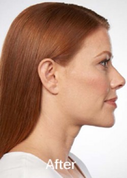 Kybella