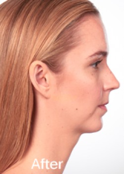 Kybella