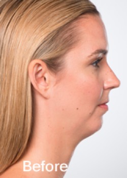 Kybella