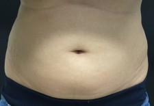 Coolsculpting