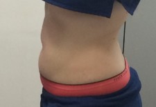 Coolsculpting