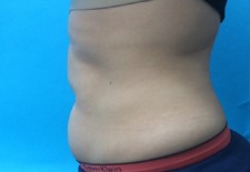 Coolsculpting