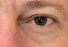 After Image: PRP Injections – under eyes - front
