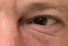 Before Image: PRP Injections – under eyes - front