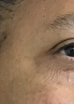 After Image: Botox – Crows Feet - front