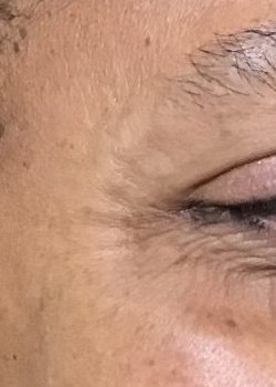 Before Image: Botox – Crows Feet - front