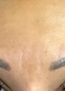After Image: Botox – Glabella - front