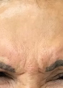 Before Image: Botox – Glabella - front